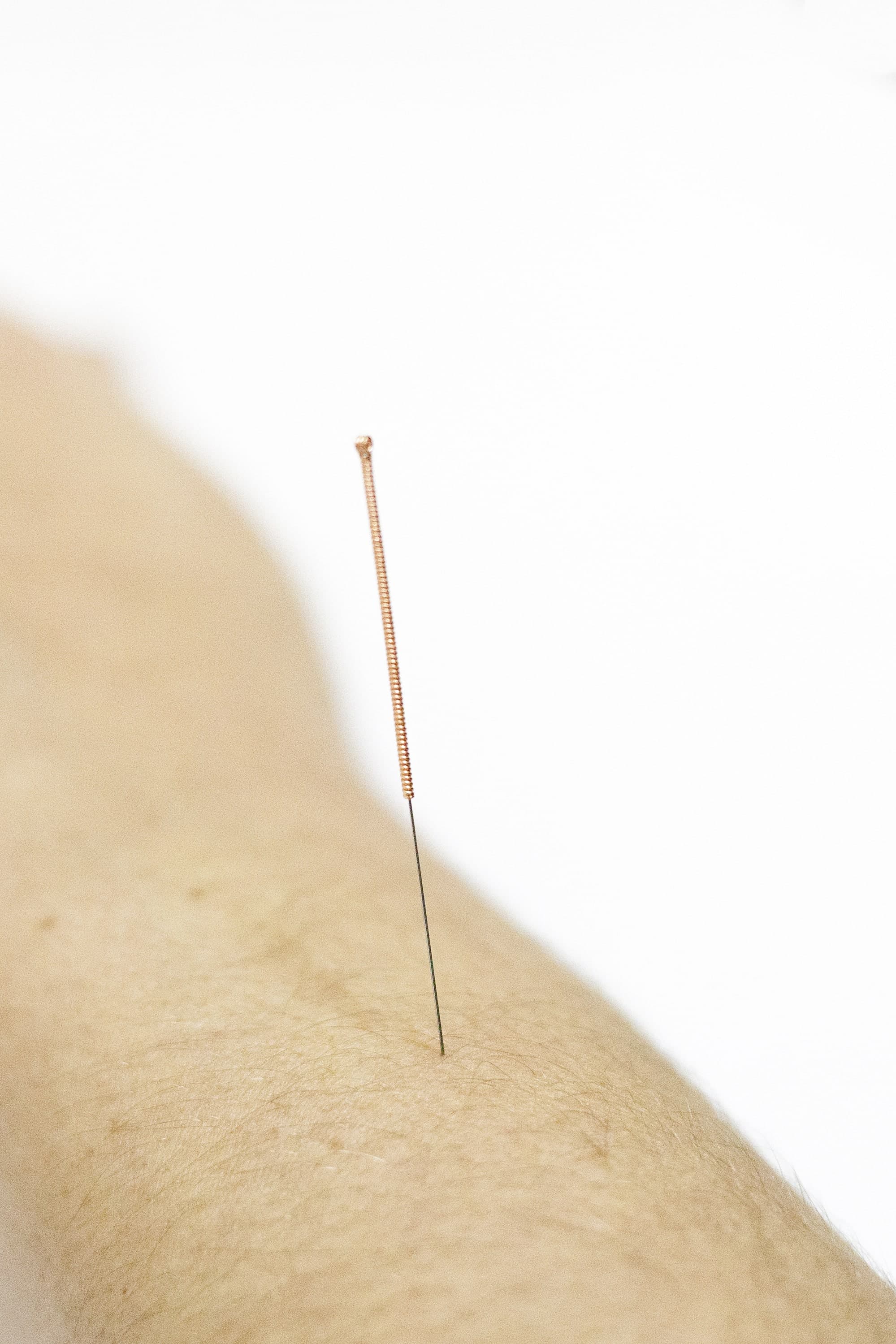 acupuntura